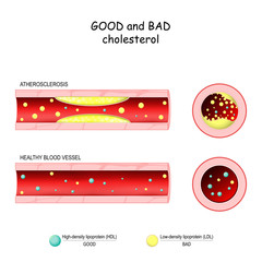 Lipid Profile Test or Lipid Panel